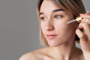 Лечение акне салициловой кислотой: как использовать, преимущества и побочные эффекты