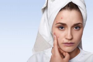 Разница между акне и прыщами: простое объяснение